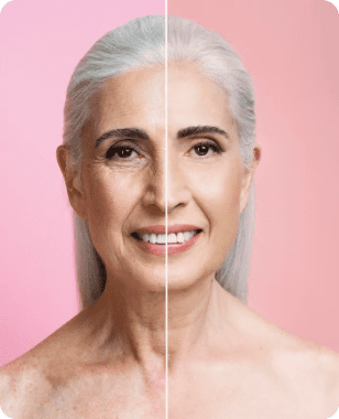 Treatment Thread Lifts