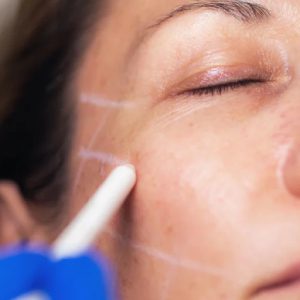 Pre-treatment preparation