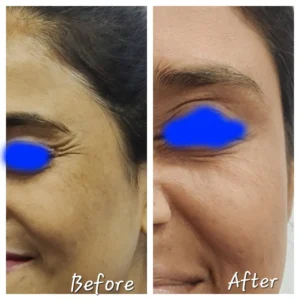 How to Eliminate Skin Wrinkles
