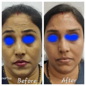 How to Eliminate Skin Wrinkles