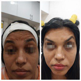 Botox