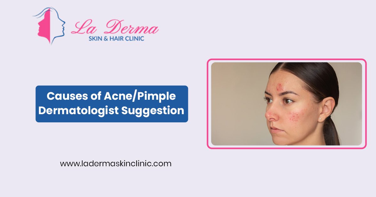 Causes of Acne/Pimple, Dermatologist Suggestion