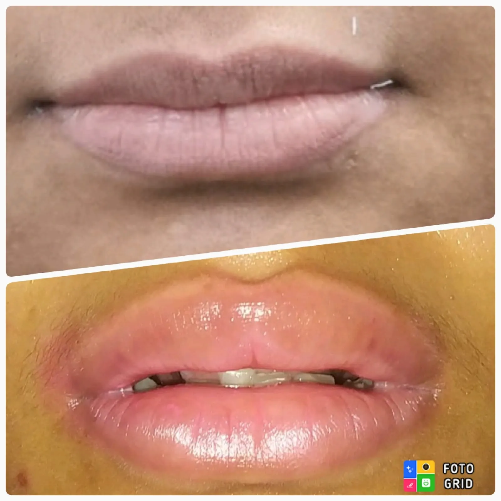Dermal Fillers