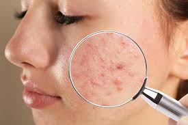 https://drkhushbutantia.com/wp-content/uploads/2025/10/Acne-Scar-Control.jpeg