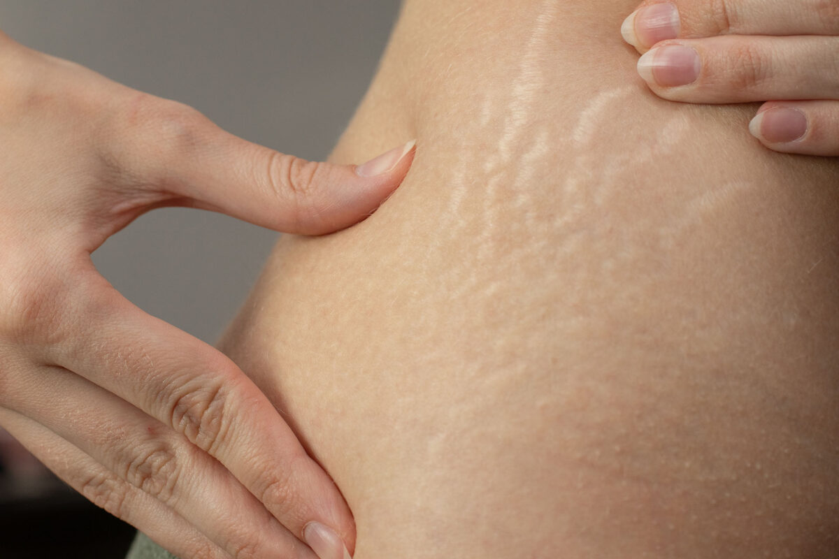 https://drkhushbutantia.com/wp-content/uploads/2025/10/Cellulite-Stretch-Mark-Toning.jpg