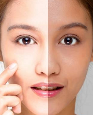 Treatment Skin Lightening Treatment