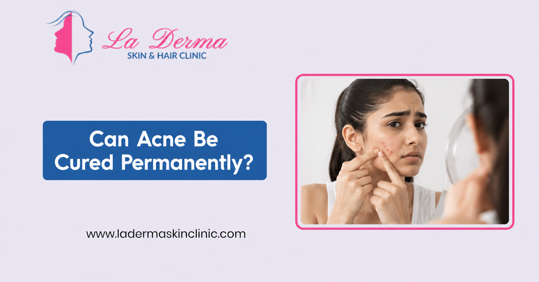 Can Acne Be Cured Permanently?