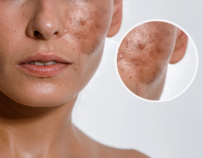 https://drkhushbutantia.com/wp-content/uploads/2026/07/Chemical-Peels.jpg