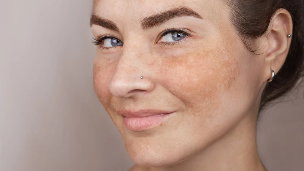 https://drkhushbutantia.com/wp-content/uploads/2026/07/Microneedling.webp