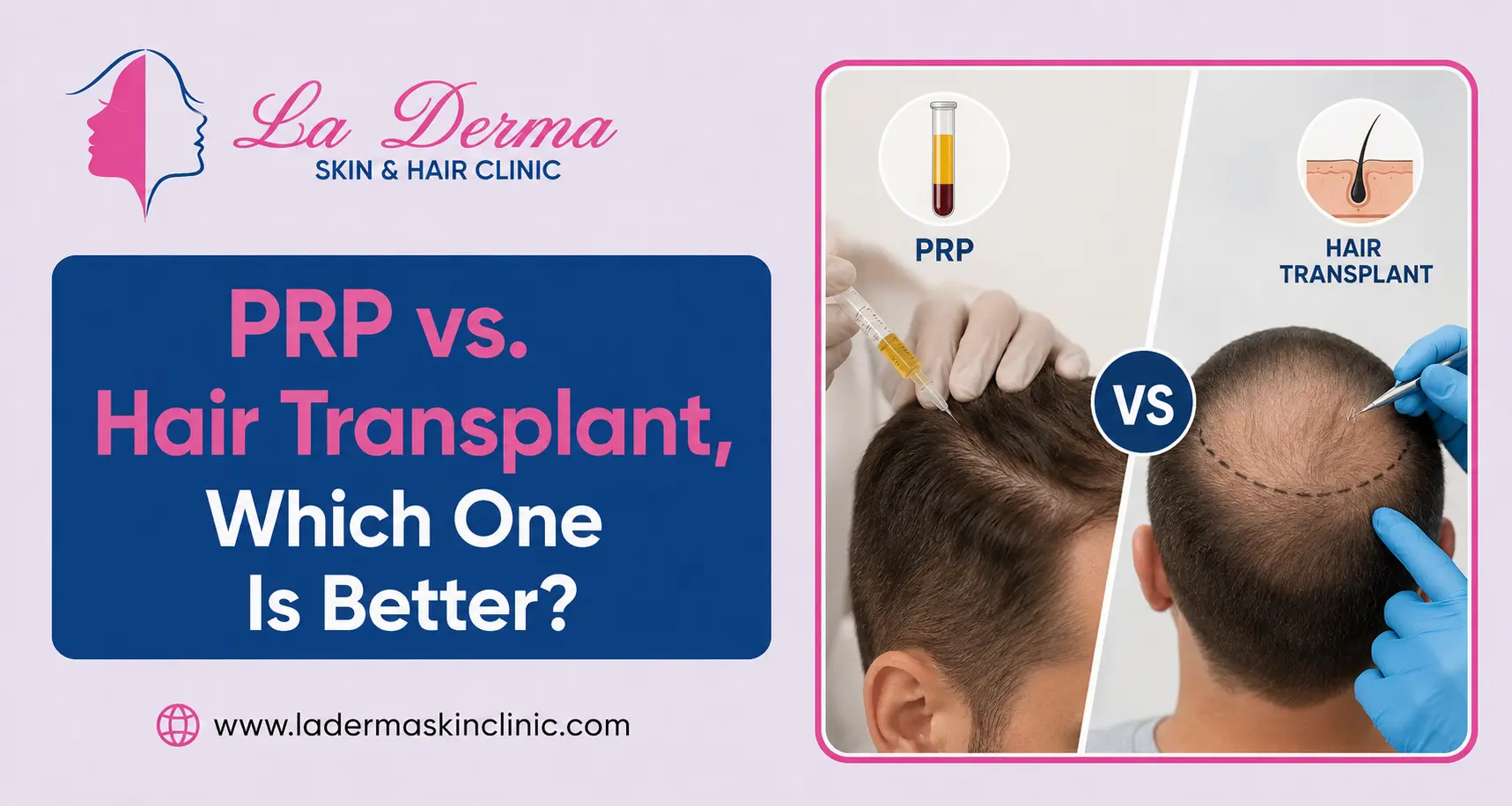 PRP vs. Hair Transplant, Which One Is Better?