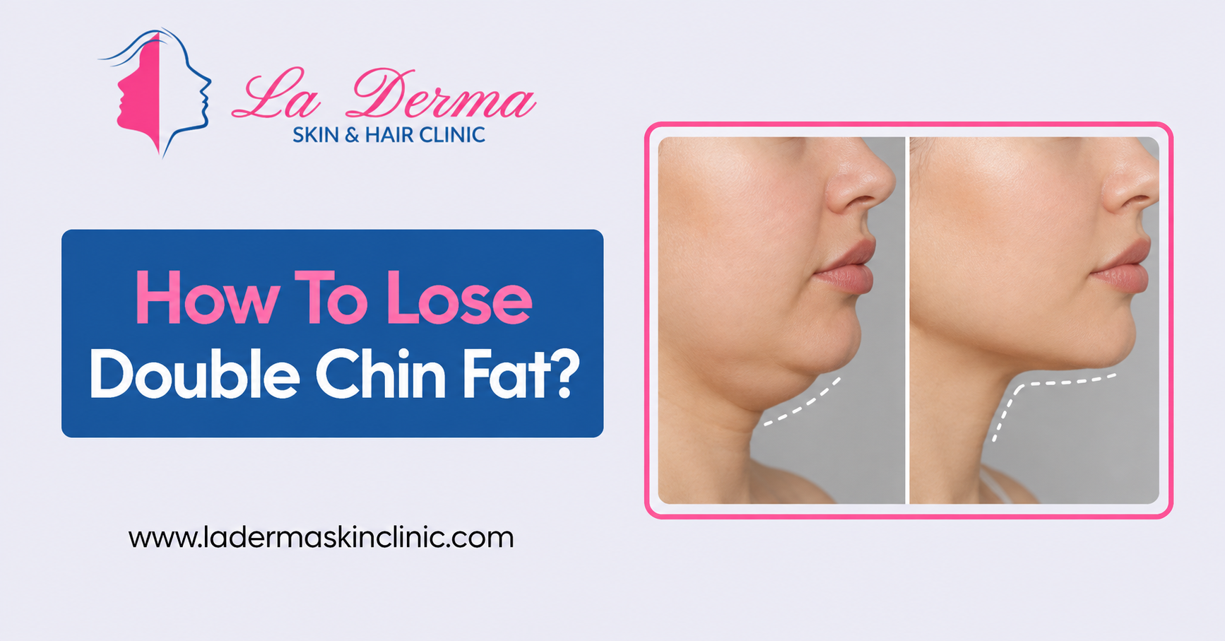 How To Lose Double Chin Fat?
